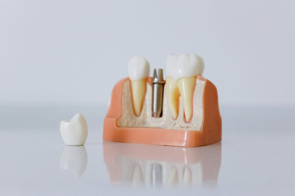 Primer plano de un modelo de implante dental que muestra dientes artificiales y la estructura mandibular.